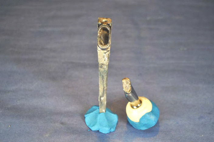 Ken Taylor broken Profemur Hip Implant System. Credit: David Komm affidavit.